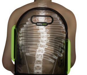 Scoliosis