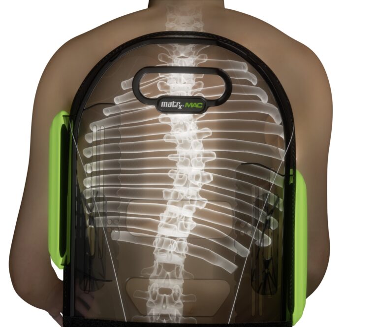 Scoliosis